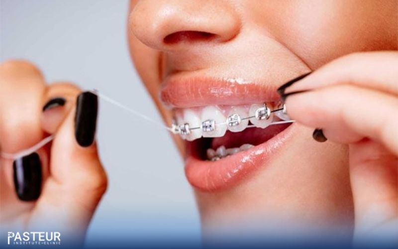 Cần chăm sóc cẩn thận răng miệng trong quá trình niềng răng