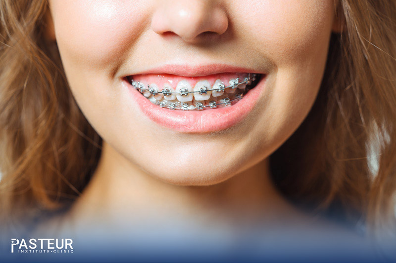 Niềng răng sẽ giúp điều trị triệt để tình trạng mặt lệch do răng mọc lộn xộn, chen chúc