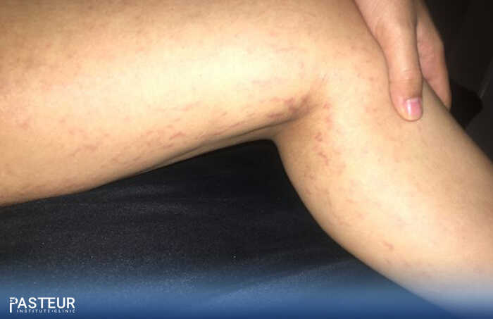 Nguyên nhân rạn da ở bắp chân