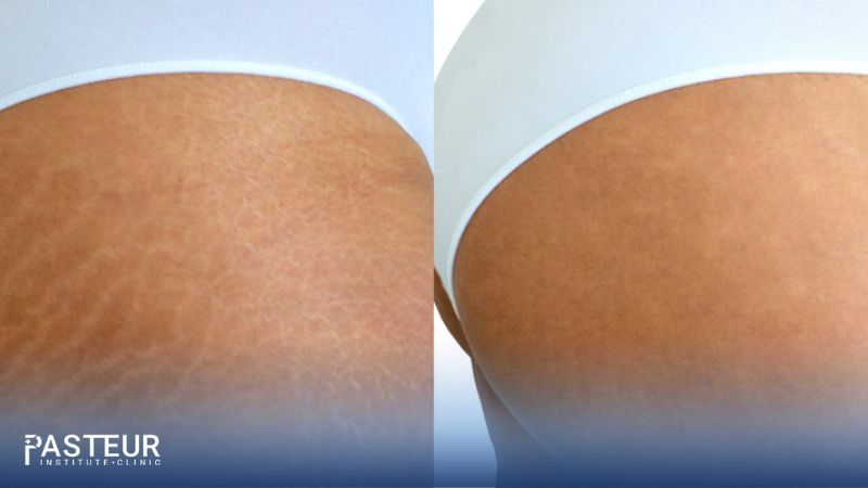Derma Extra trị rạn da an toàn, phục hồi da mịn màng lên tới 95%