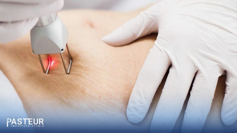 Tìm hiểu về kỹ thuật bắn tia laser trị rạn da