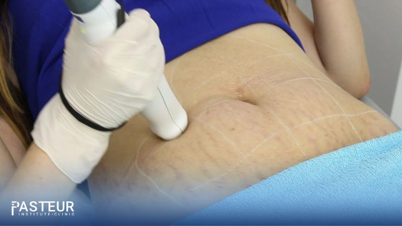 Có nên trị rạn da sau sinh bằng laser không?